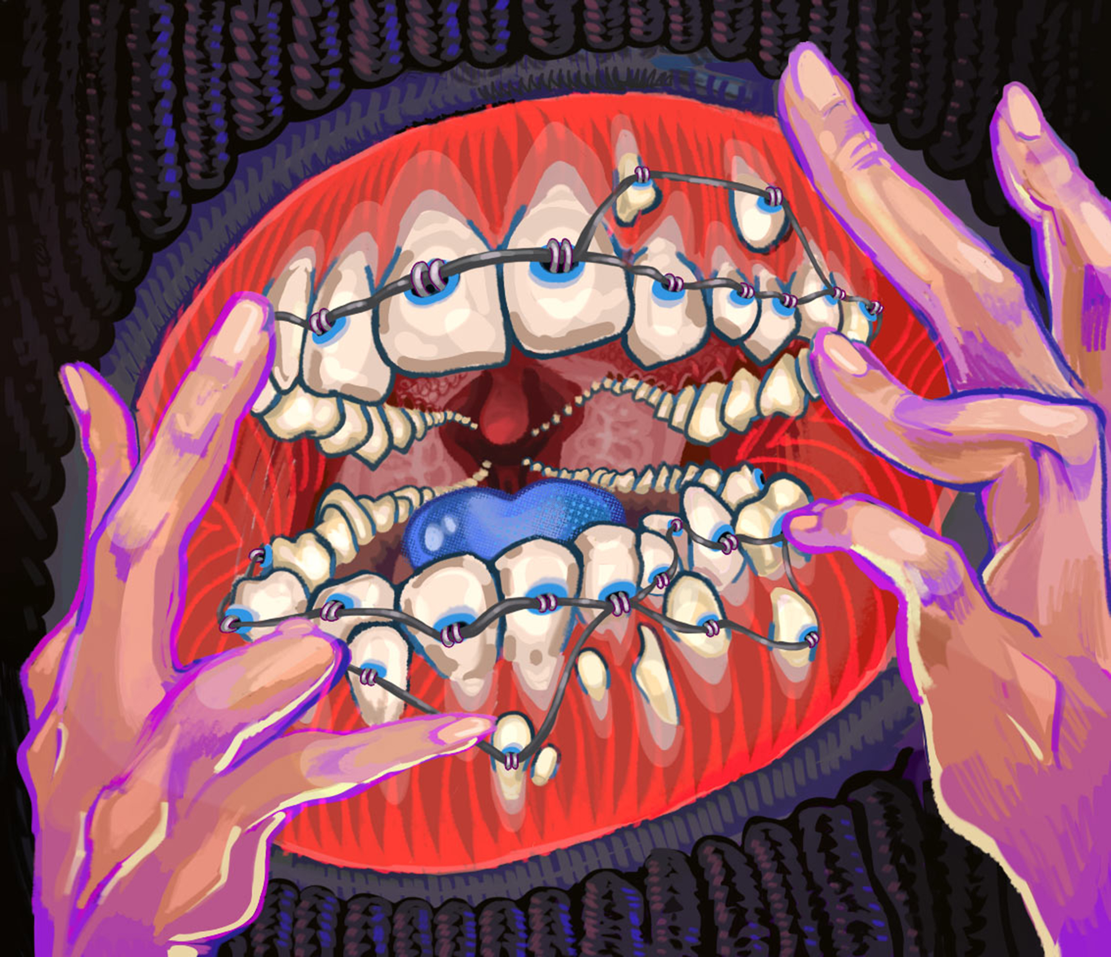 Garish pairing in red, blue, black, and white of two hands holding open a mouth full of teeth with braces